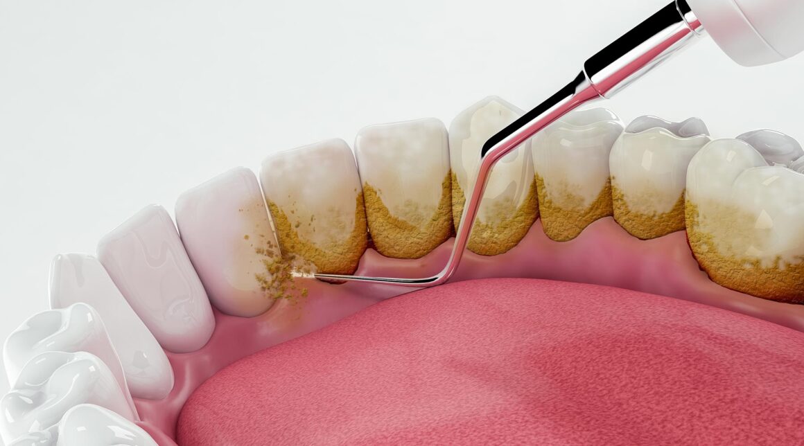 Scaling and Gum surgeries