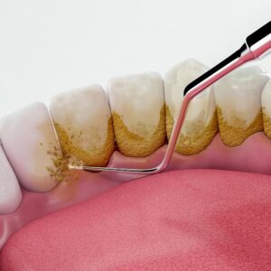 Scaling and Gum surgeries