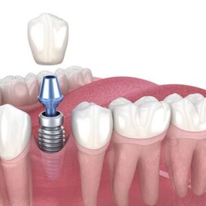 Dental and zygomatic implants