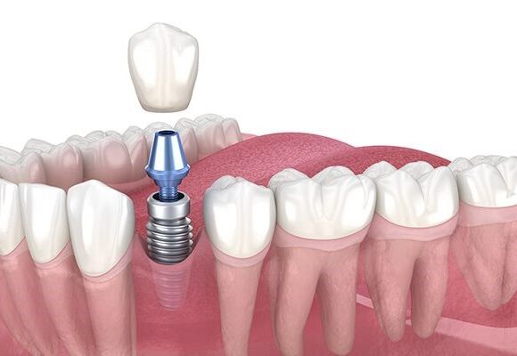 Dental and zygomatic implants