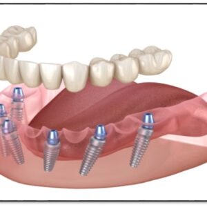 Full mouth rehabilitation