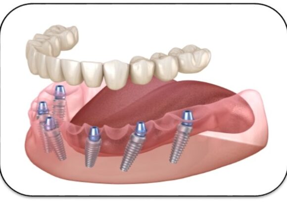 Full mouth rehabilitation