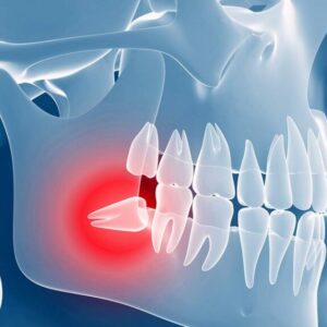 Oral and maxillofacial surgeries