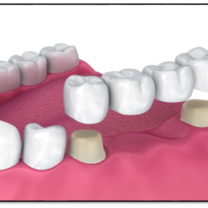 Replacement of missing teeth: crown and bridges and dentures