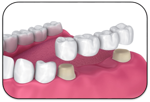 Replacement of missing teeth: crown and bridges and dentures