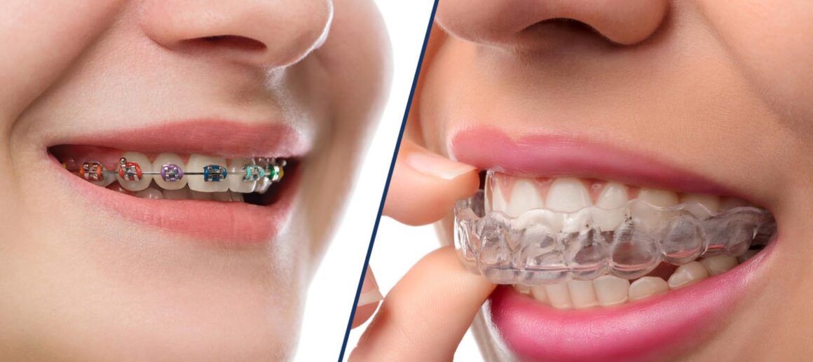 Braces and invisible aligners (invisalign)