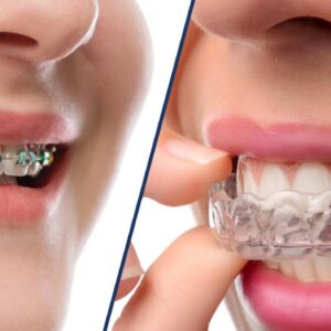 Braces and invisible aligners (invisalign)